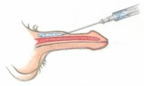 Injections d'acide hyaluronique